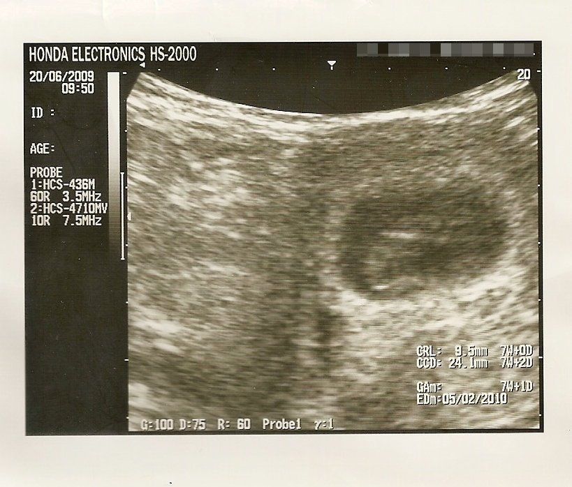 ultrasonido-minibebé